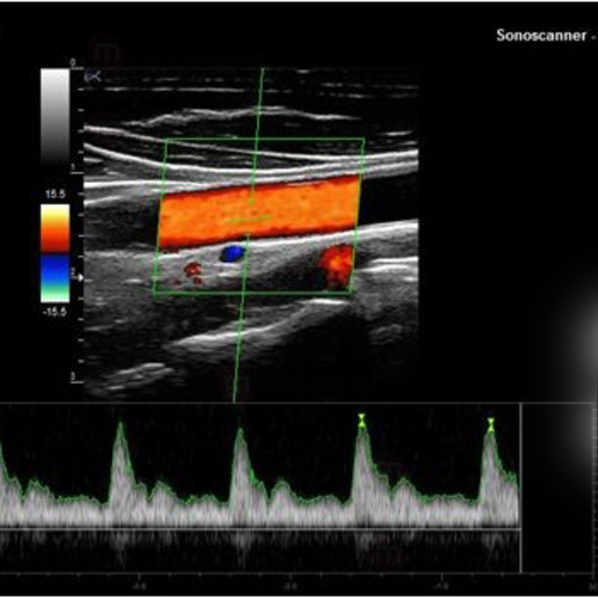 ORCHEOLITE Echographe HD Sonoscanner Orcheo Lite M8