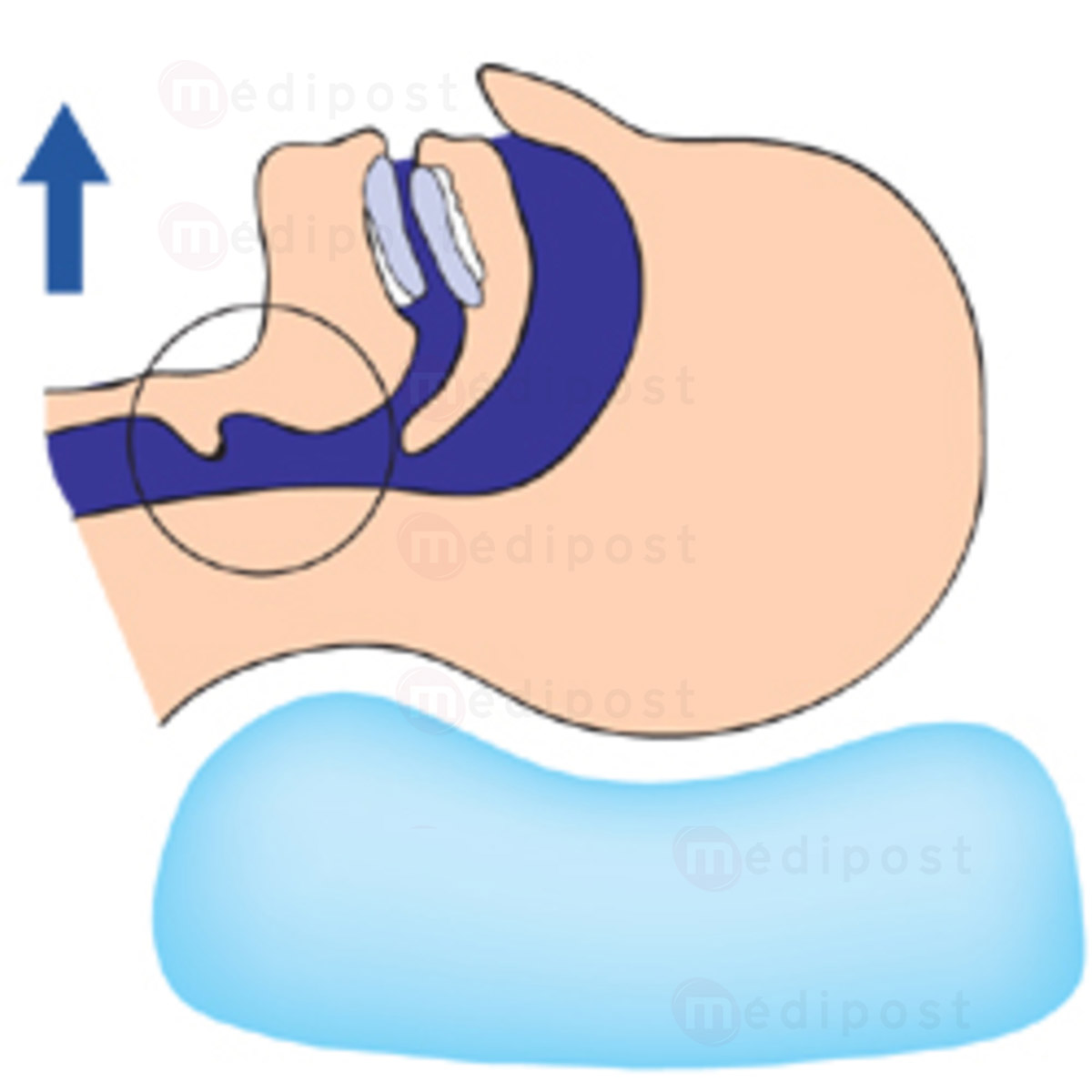 SOMNOFIT Orthèse mandibulaire thermoformable M03