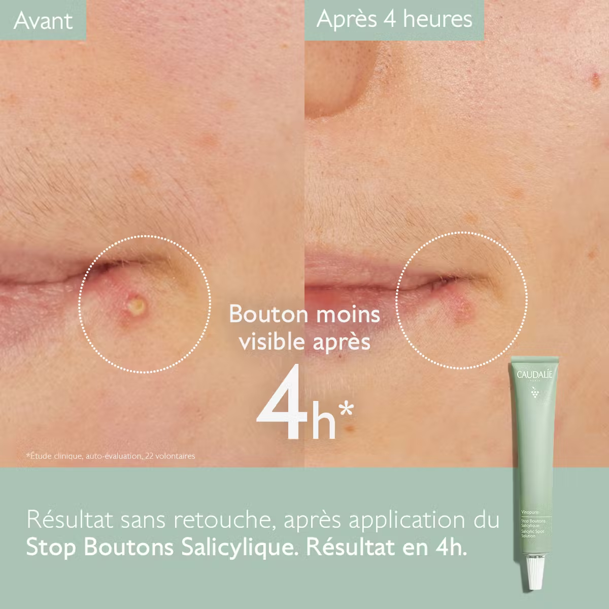 CAUDALIE VINOPURE STOP BOUTONS SALICYLIQUE 15ML M03