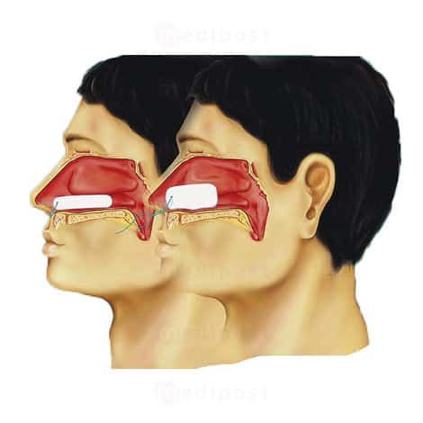 Mèche nasale stérile pour épistaxis Raucocel